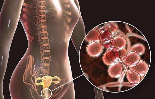 síntomas de infección por hongos en la vulva